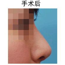 鼻子假体图片,揭秘美丽蜕变背后的秘密